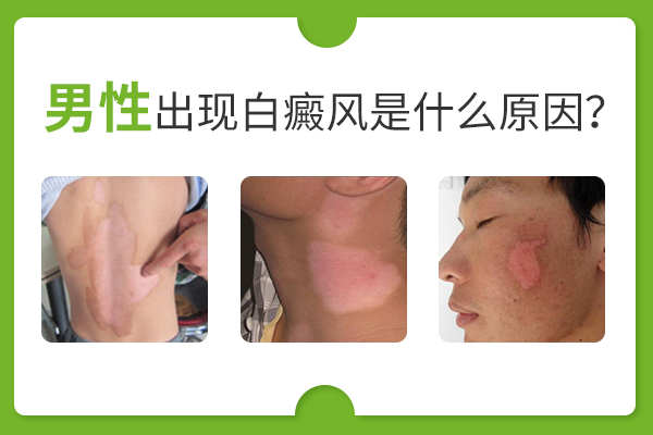 男性身上會(huì)出現(xiàn)白癜風(fēng)是哪些因素導(dǎo)致的?