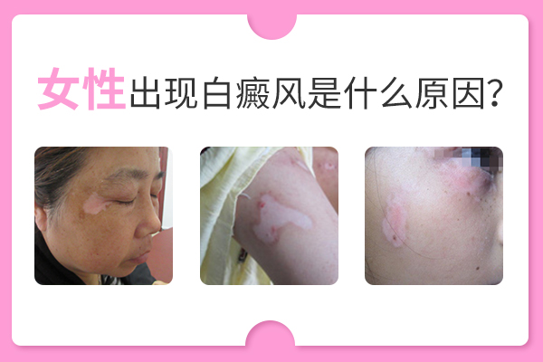 誘發(fā)女性長白癜風的原因有哪些呢？