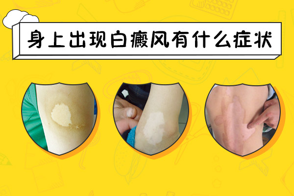 身上出現(xiàn)白癜風(fēng)有什么癥狀呢？
