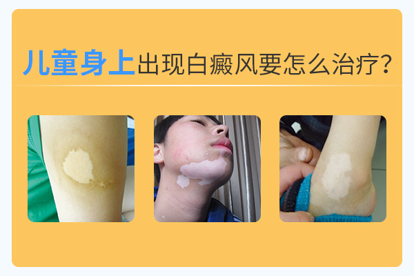 兒童治療白癜風(fēng)過(guò)程中要避開(kāi)什么呢？