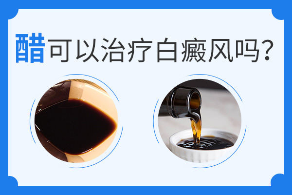 喝醋真的能夠治療白癜風(fēng)嗎？
