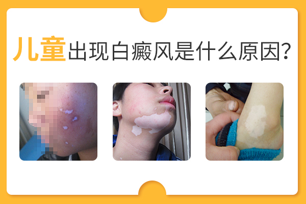 合肥兒童會因為什么原因而患上白癜風(fēng)呢？