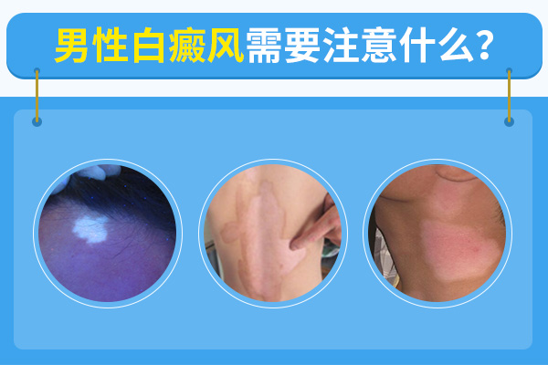 合肥男性確診得了白癜風(fēng)要怎么做才好呢？